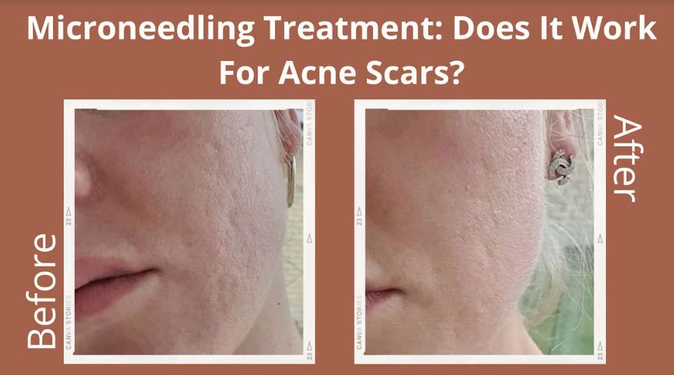 Microneedling Treatment: Does It Work For Acne Scars?